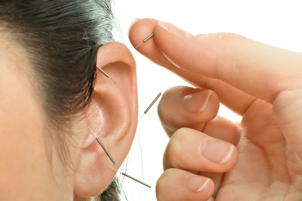 woman receiving auricular acupuncture