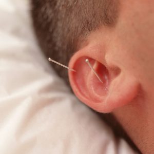 auricular therapy treatment