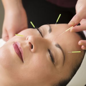 facial acupuncture treatment